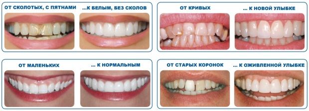 Что такое виниры? Что такое виниры?