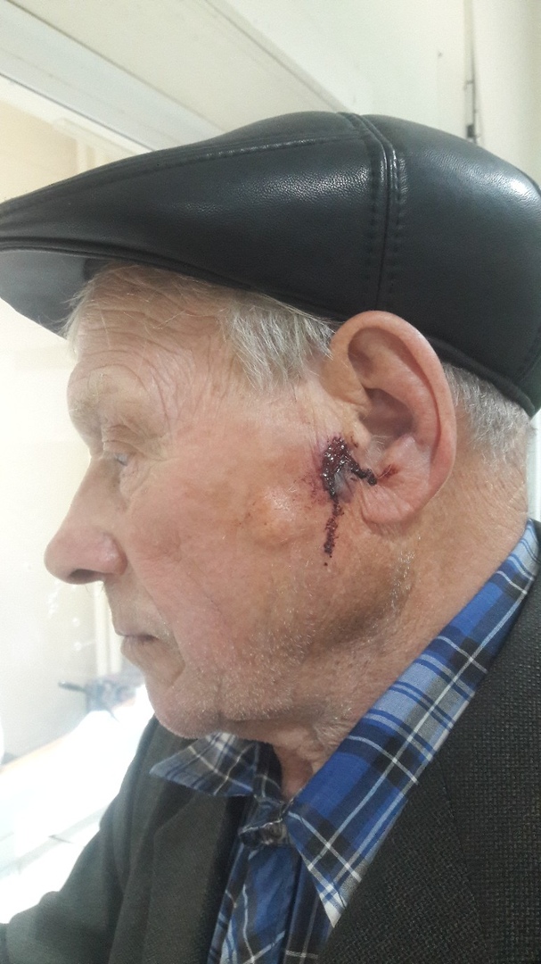 В Омске 89-летний пенсионер показал лицо после избиения за дачный участок В Омске 89-летний пенсионер показал лицо после избиения за дачный участок