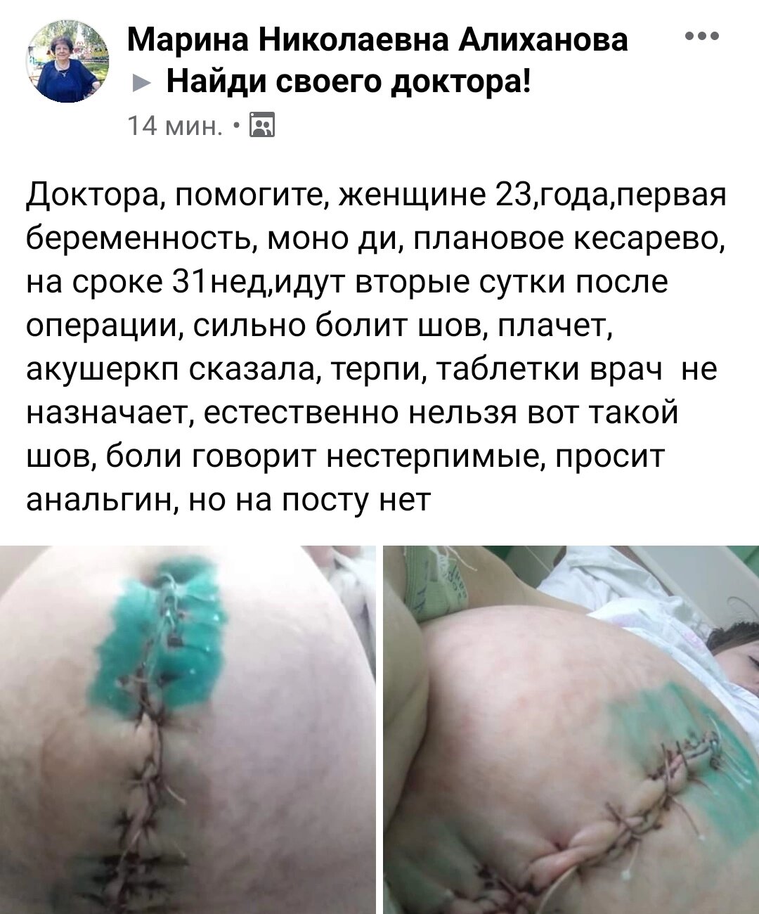 Молодая омичка пожаловалась на незаживающий шов после кесарева сечения – соцсети Молодая омичка пожаловалась на незаживающий шов после кесарева сечения – соцсети